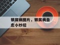 银屑病图片，银屑病自愈小妙招