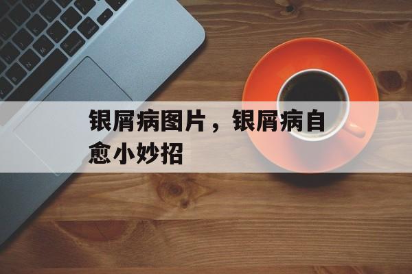 银屑病图片，银屑病自愈小妙招-第1张图片-